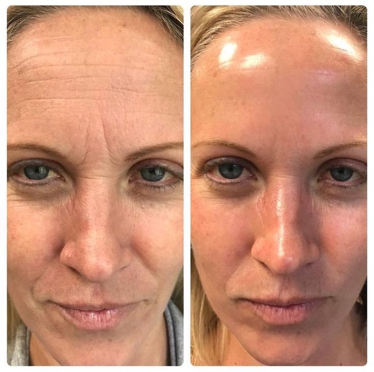 Le duvet et la pilosité du visage changent-ils avec l'âge ?